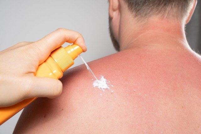 Alergija na sunce: Jedan je znak da ste preterali sa sunèanjem i da vam hitno treba lek